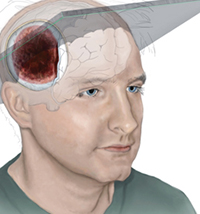 Medical Legal Illustration - epidural hematoma case study